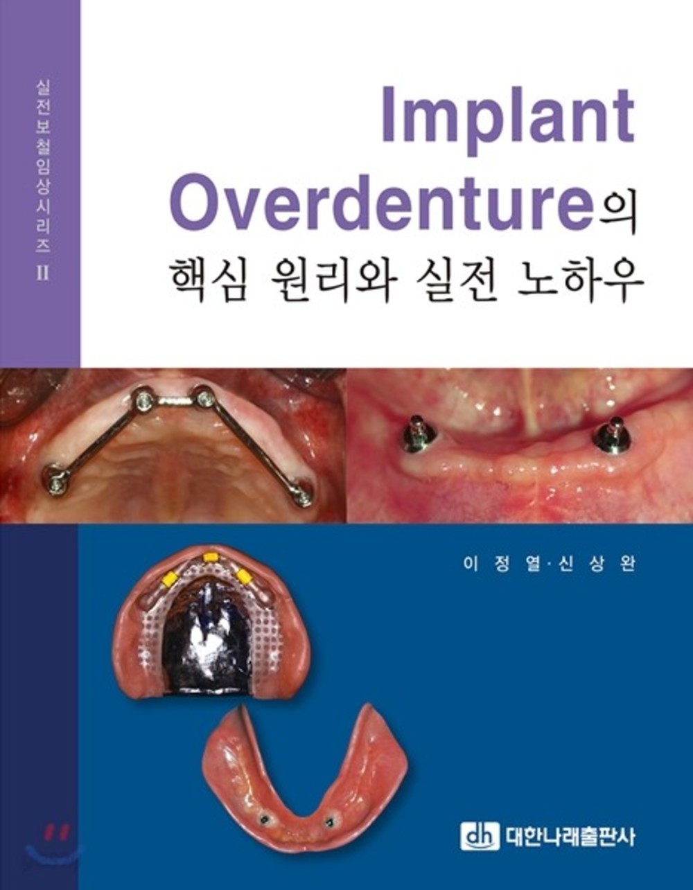 Implant Overdenture의 핵심 원리와 실전 노하우